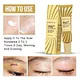 Acne Treatment