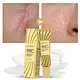 Acne Treatment